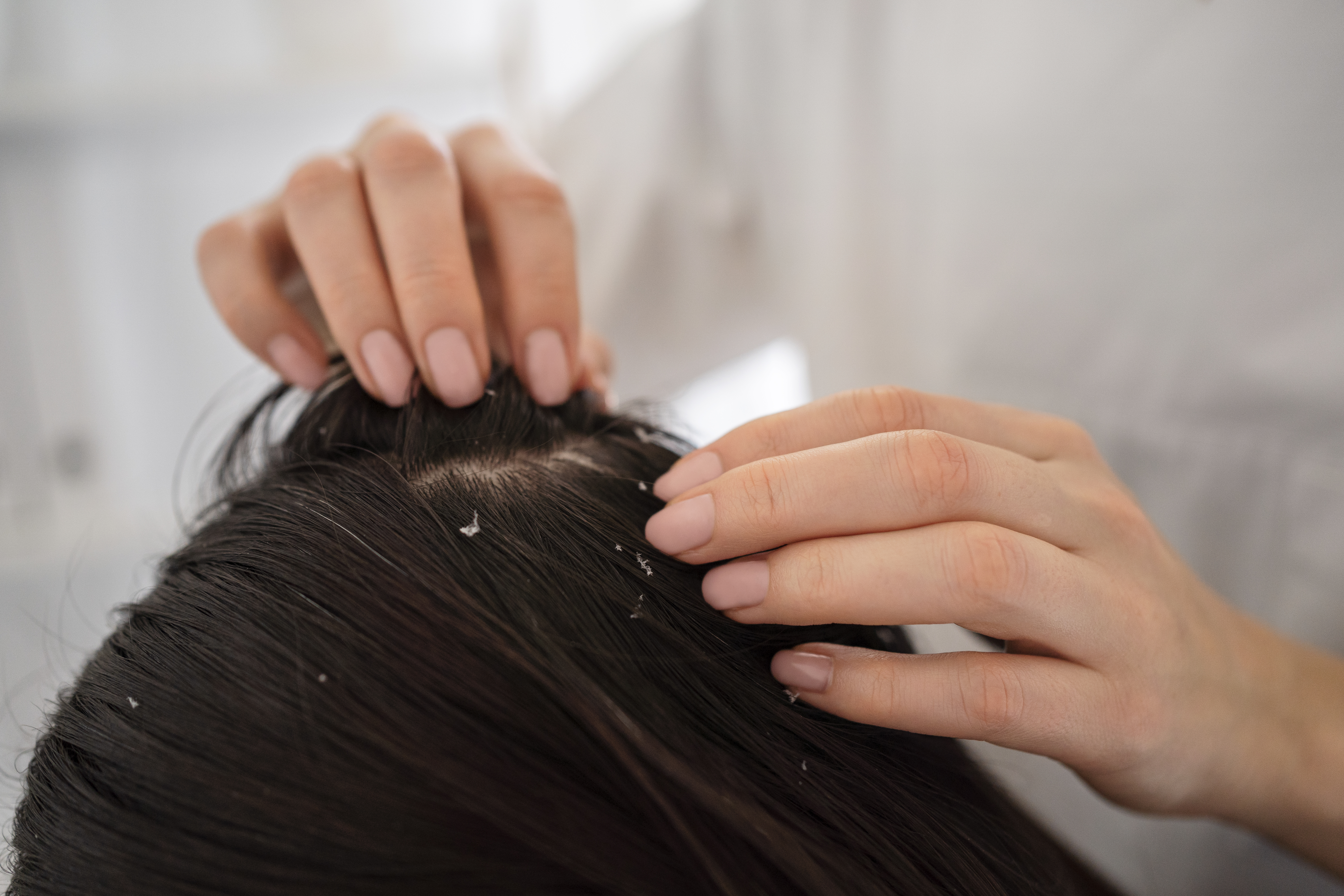 Can Dandruff Cause Hair Fall? Dermatologist Explains