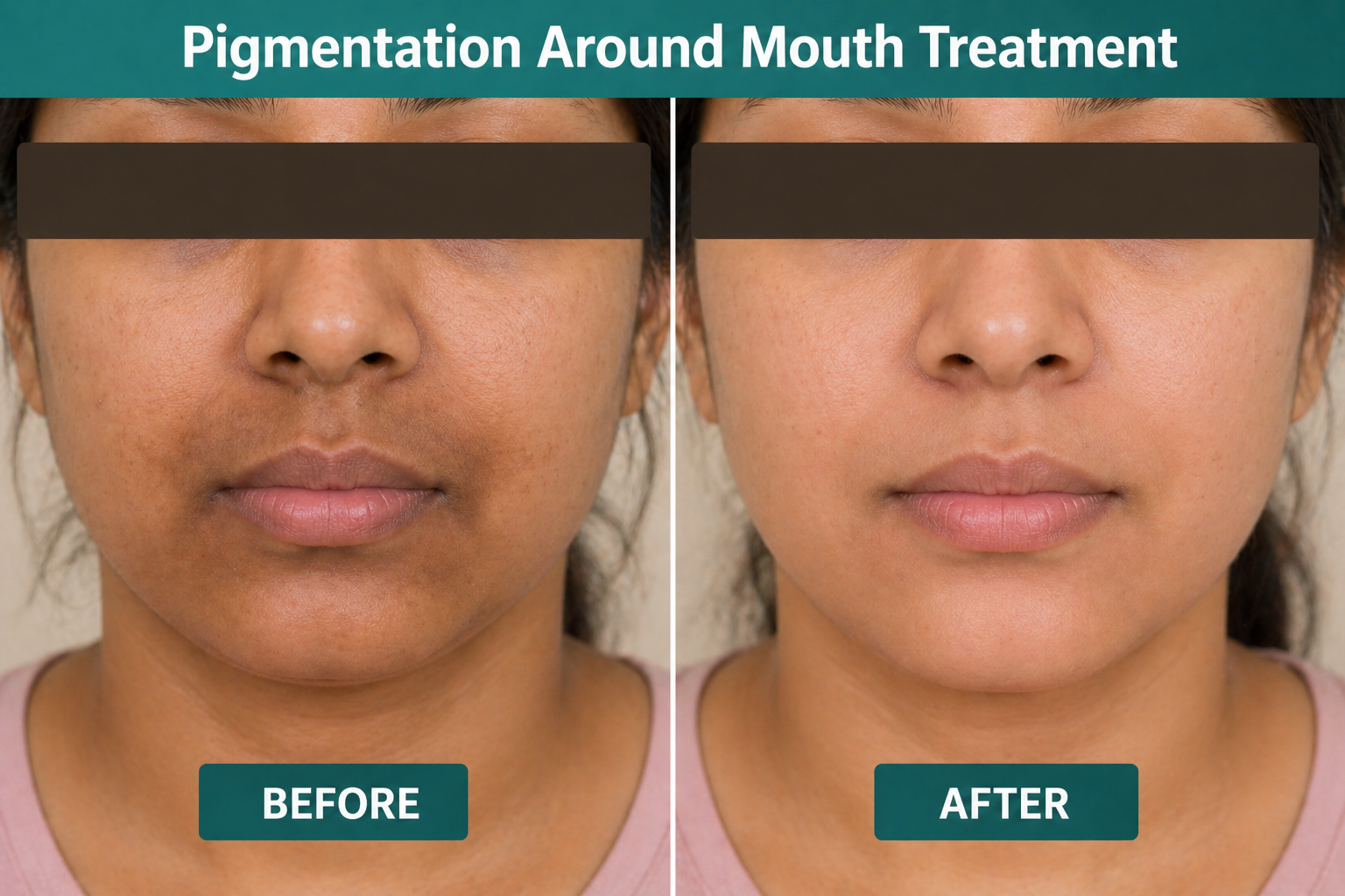 Dermatologist-Recommended Treatments for Pigmentation Around the Lips