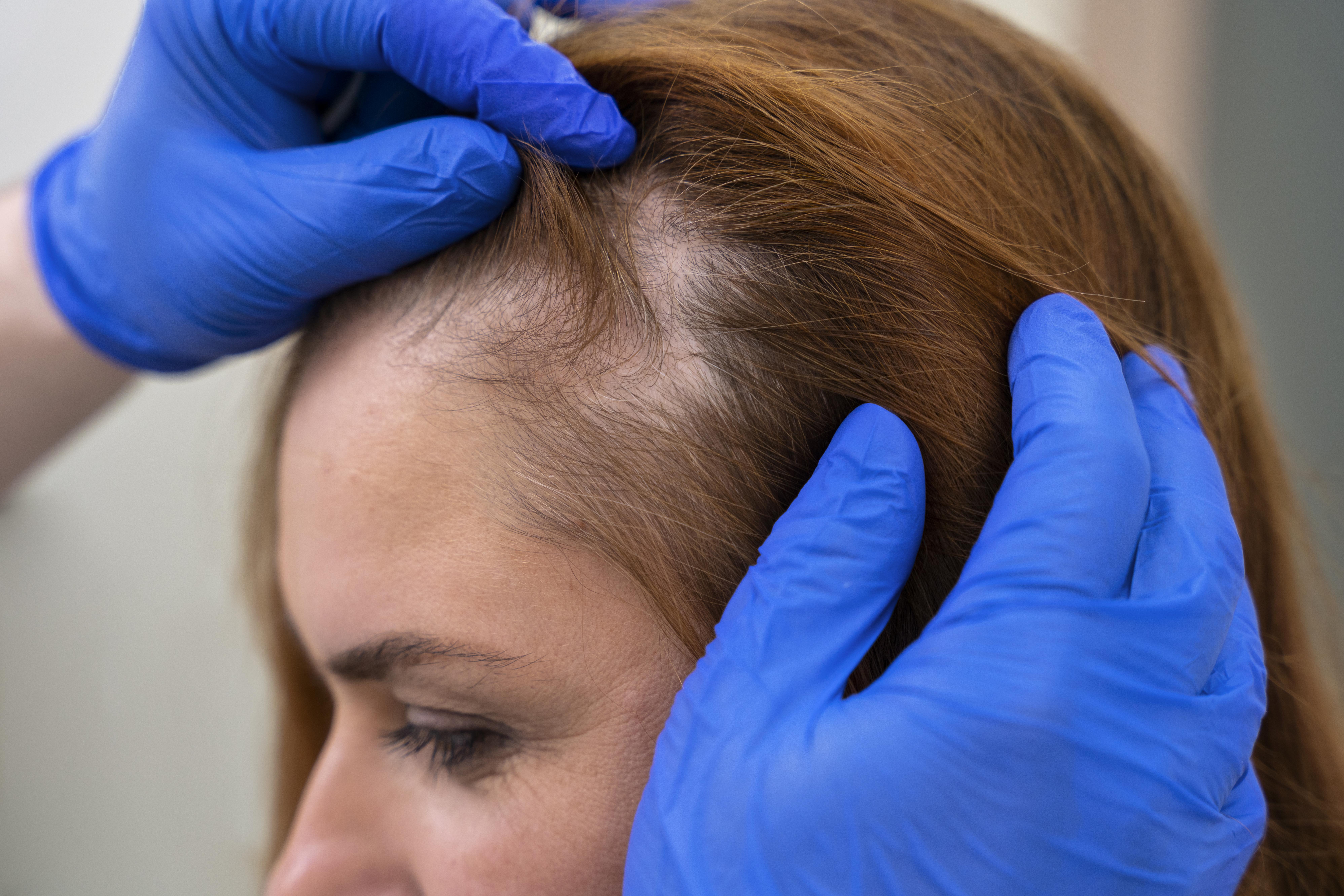 How Exosome Therapy Helps Improve Hair Thickness and Restore Natural Volume