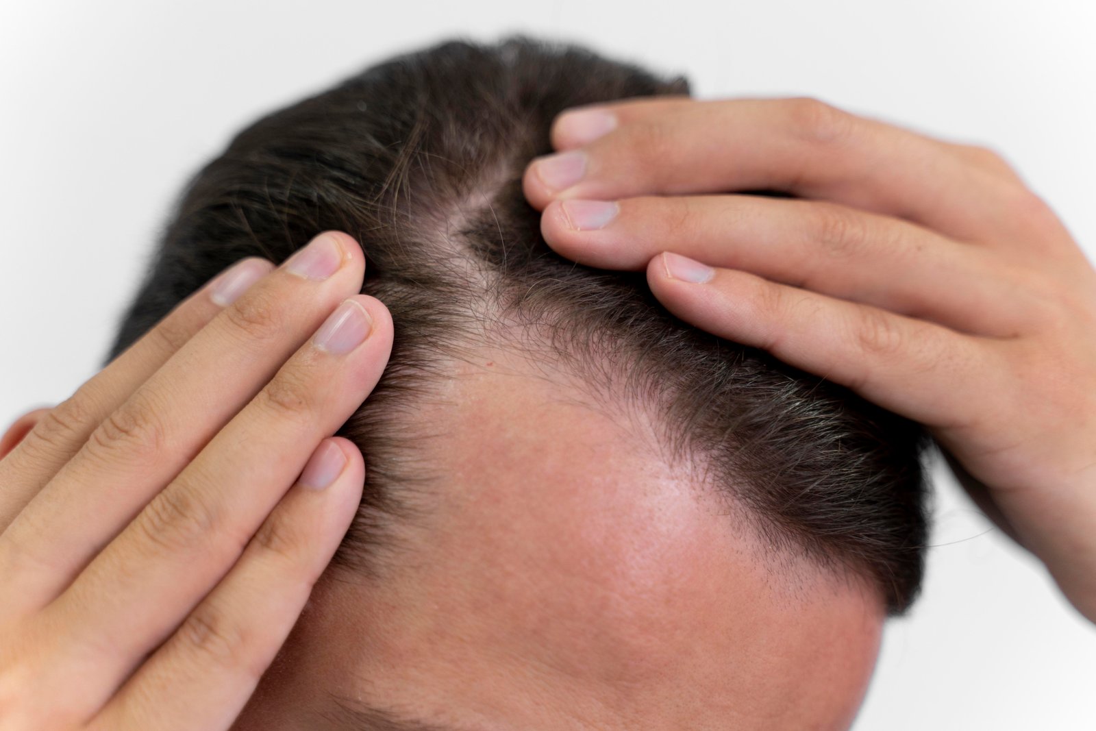 Hair Thinning: Causes, Early Signs and Effective Treatment Options