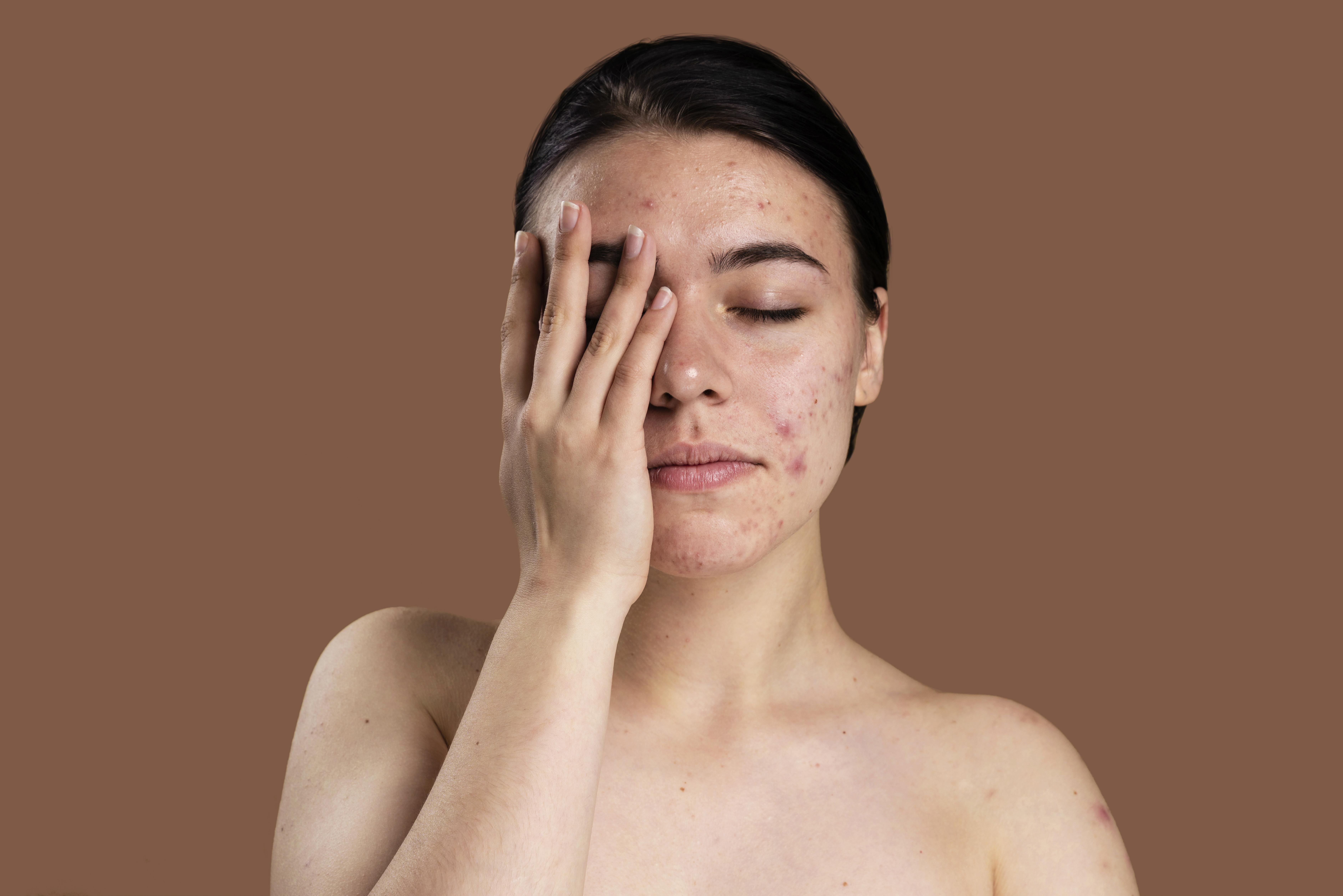 Acne and Its Aesthetic Treatment Options