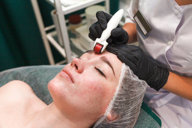 Collagen Acne Scar Treatment: How It Works?
